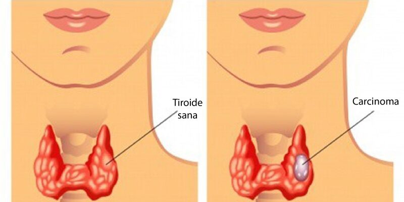 Carcinoma-tiroideo-800×400