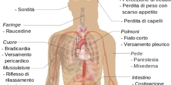 Ipotiroidismo-800×400 morbo di basedow a pisa
