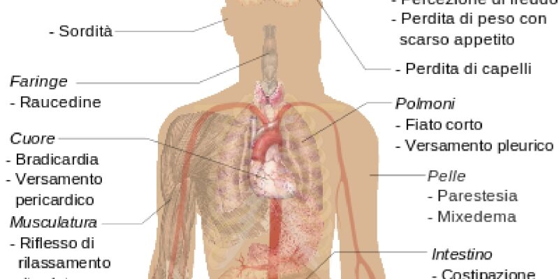 morbo di basedow a pisa