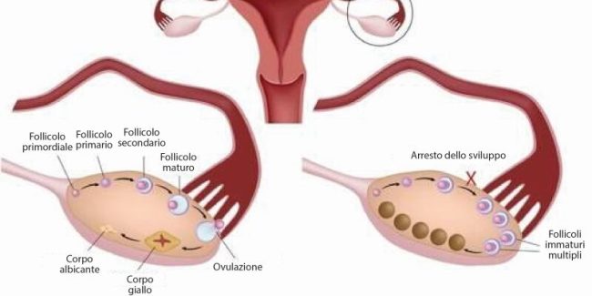 Ovaio-policistico-800×400