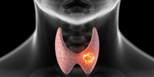 nodulo-tiroideo-2-600×300 nodulo tiroideo