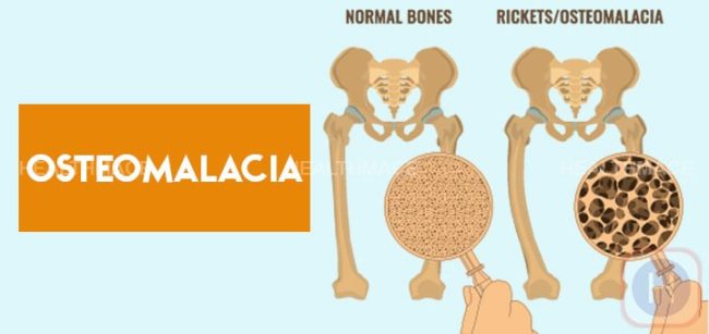 Effetti In Attesi Della Vitamina-D Effetti In Attesi Della Vitamina-D