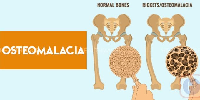 Effetti In Attesi Della Vitamina-D